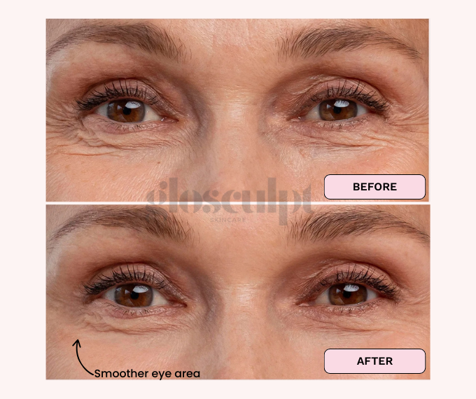 YOUNGER LOOKING EYE AREA