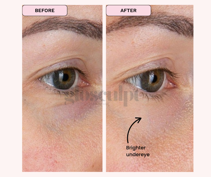 Refreshed, Brighter Undereyes