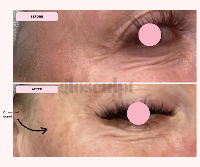 REAL RESULTS: Softer Crow&#39;s Feet