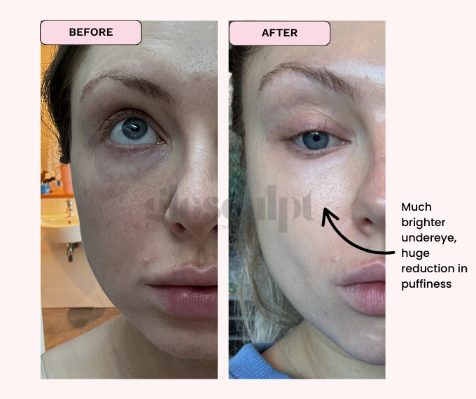 BYE BYE DARK CIRCLES