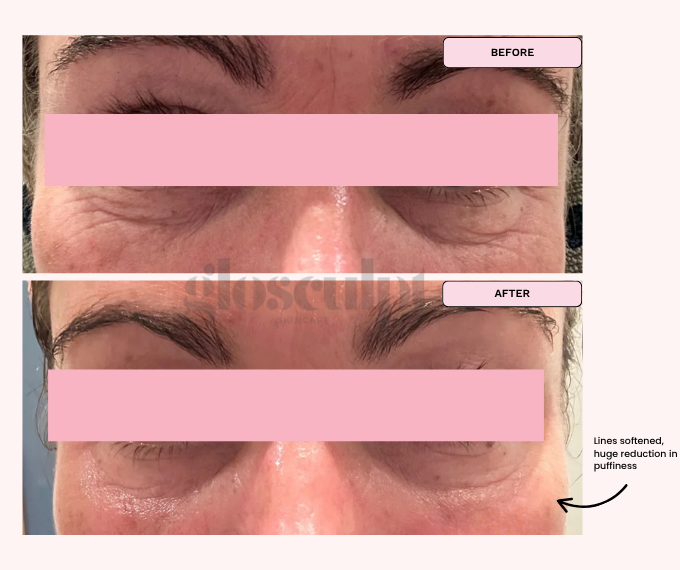 REAL RESULTS: Reduced Bags