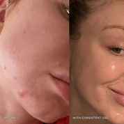 7 - in - 1 Acne Glo Shield - GloSculpt Skin