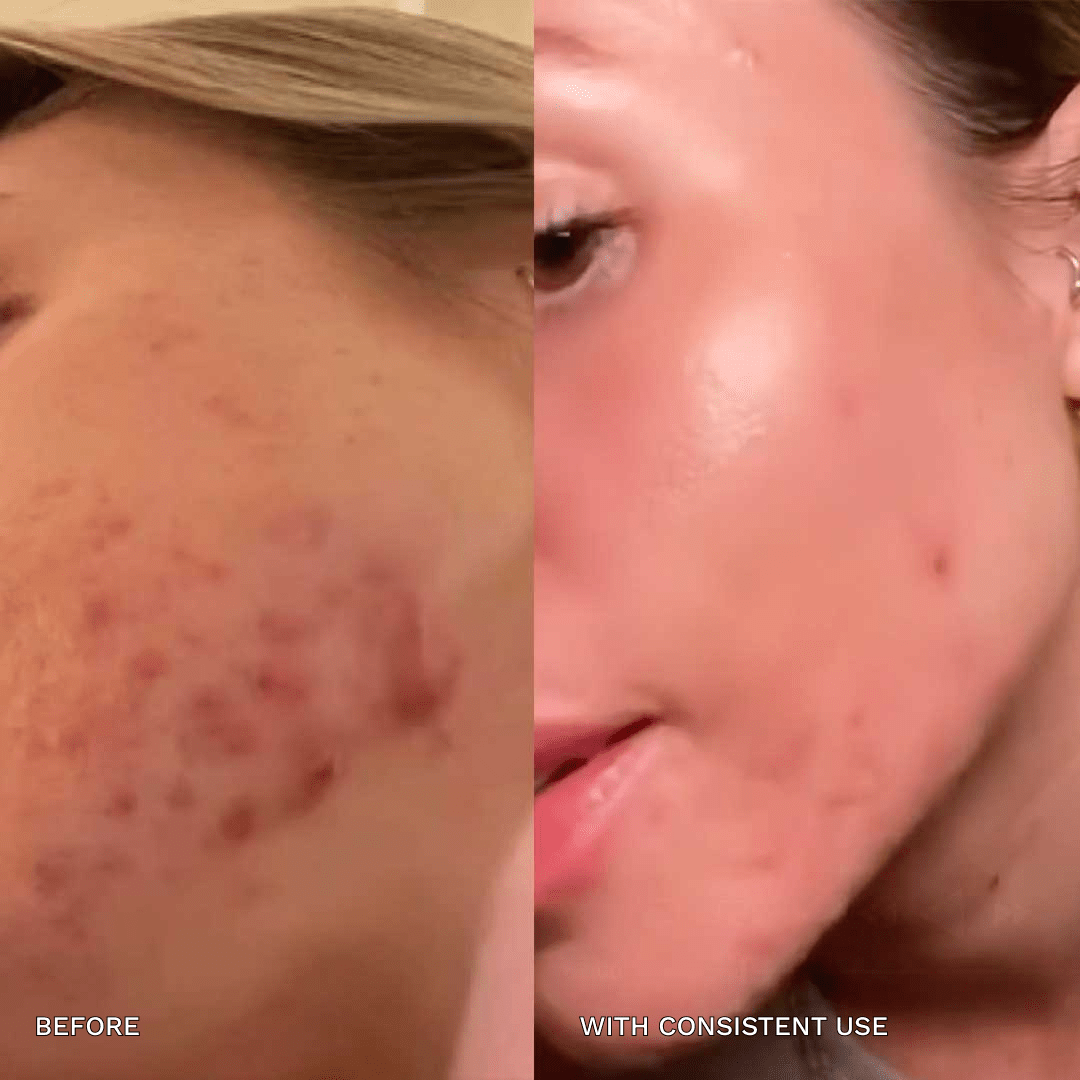7 - in - 1 Acne Glo Shield - GloSculpt Skin