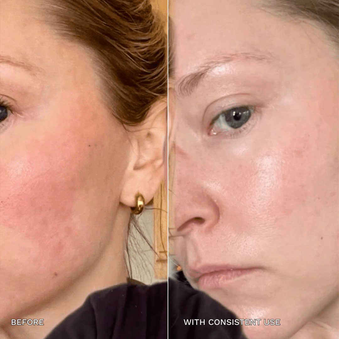 7 - in - 1 Acne Glo Shield - GloSculpt Skin