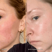 7 - in - 1 Acne Glo Shield - GloSculpt Skin