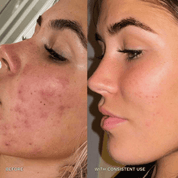 7 - in - 1 Acne Glo Shield - GloSculpt Skin