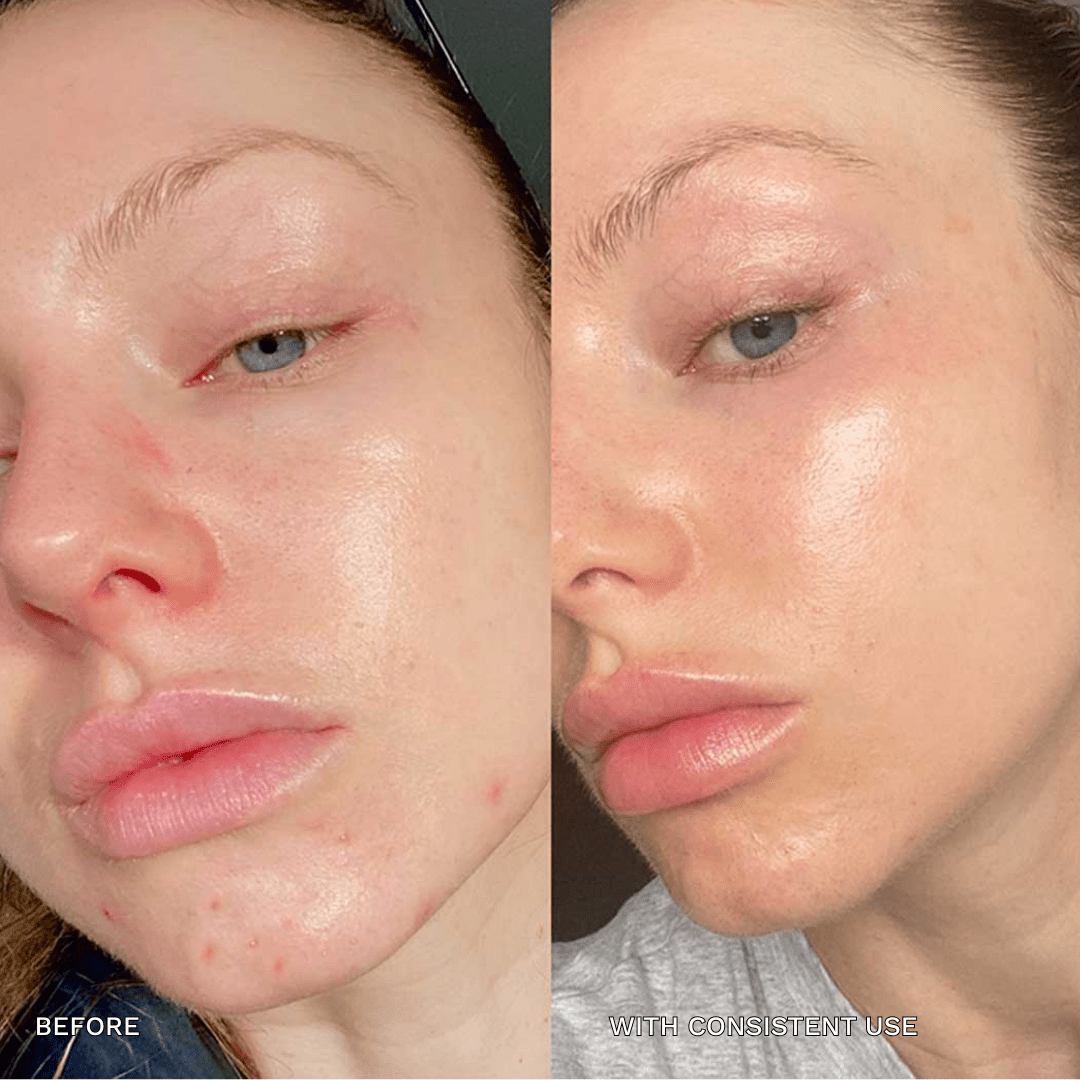 7 - in - 1 Acne Glo Shield - GloSculpt Skin
