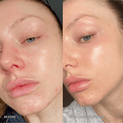 7 - in - 1 Acne Glo Shield - GloSculpt Skin
