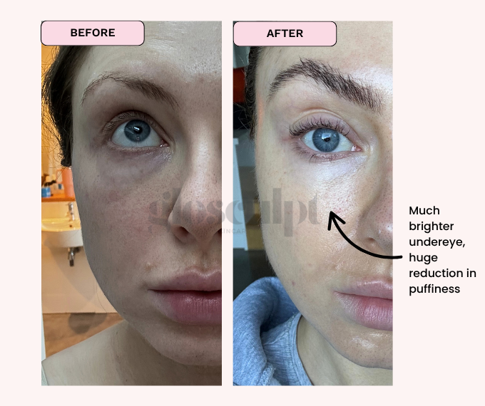 BYE BYE DARK CIRCLES