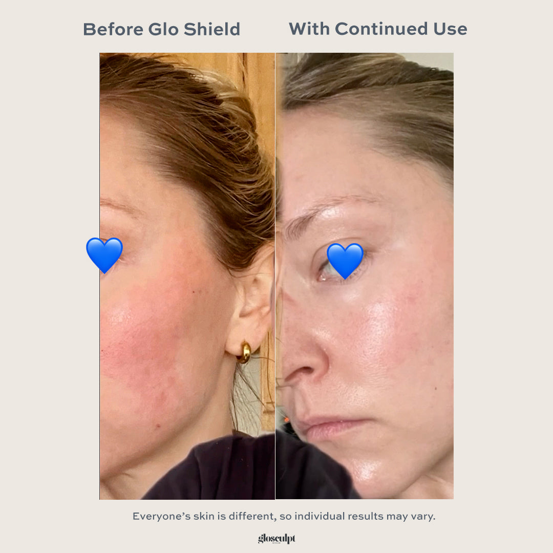 acnebeforeandafter3.jpg