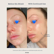Glo 7-in-1 LED Light Therapy Shield