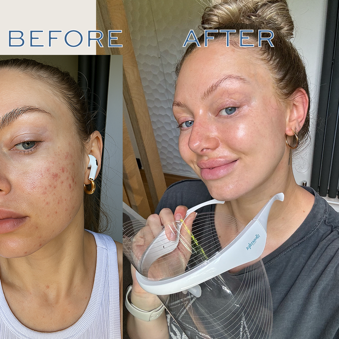 Glo 7-in-1 LED Light Therapy Shield