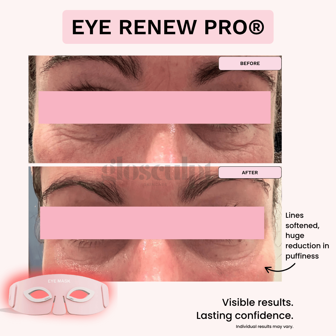Eye Renew Pro®: 4 - in - 1 Bright Eyes Red Light Mask - GloSculpt Skin
