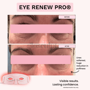 Eye Renew Pro®: 4 - in - 1 Bright Eyes Red Light Mask - GloSculpt Skin