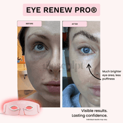 Eye Renew Pro®: 4 - in - 1 Bright Eyes Red Light Mask - GloSculpt Skin
