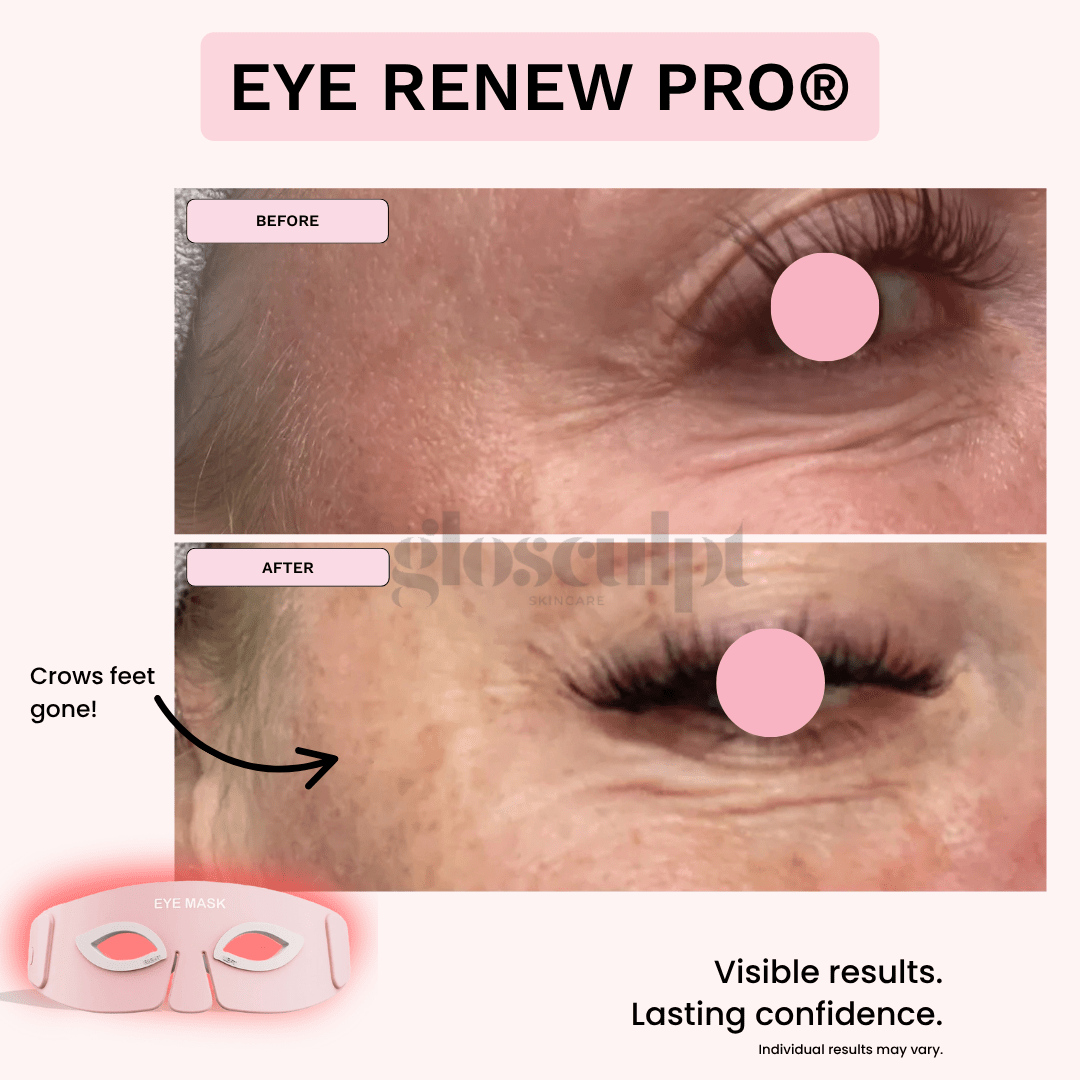 Eye Renew Pro®: 4 - in - 1 Bright Eyes Red Light Mask - GloSculpt Skin