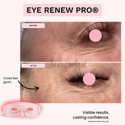Eye Renew Pro®: 4 - in - 1 Bright Eyes Red Light Mask - GloSculpt Skin