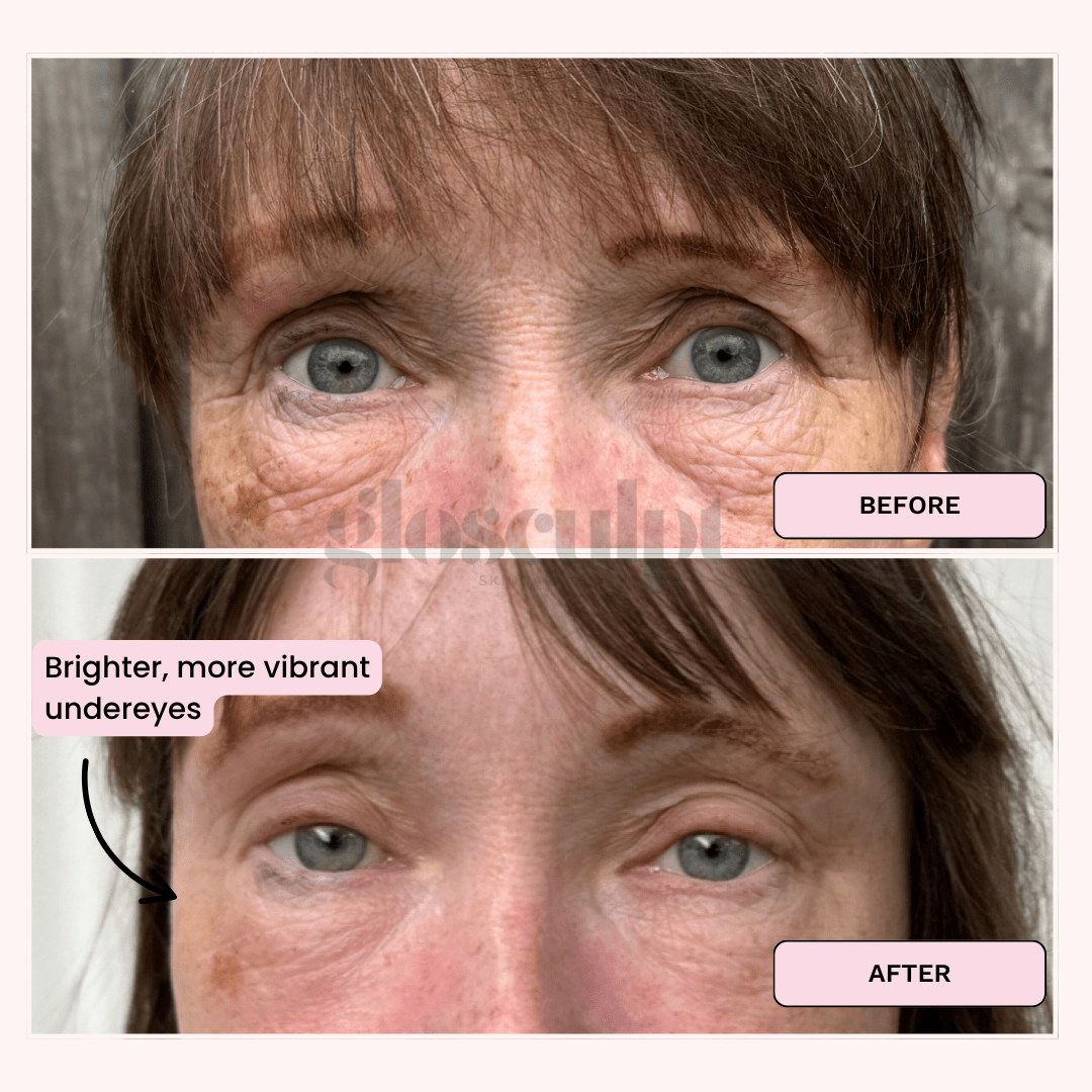 Eye Renew Pro - Bright Eyes Red Light Mask - GloSculpt Skin