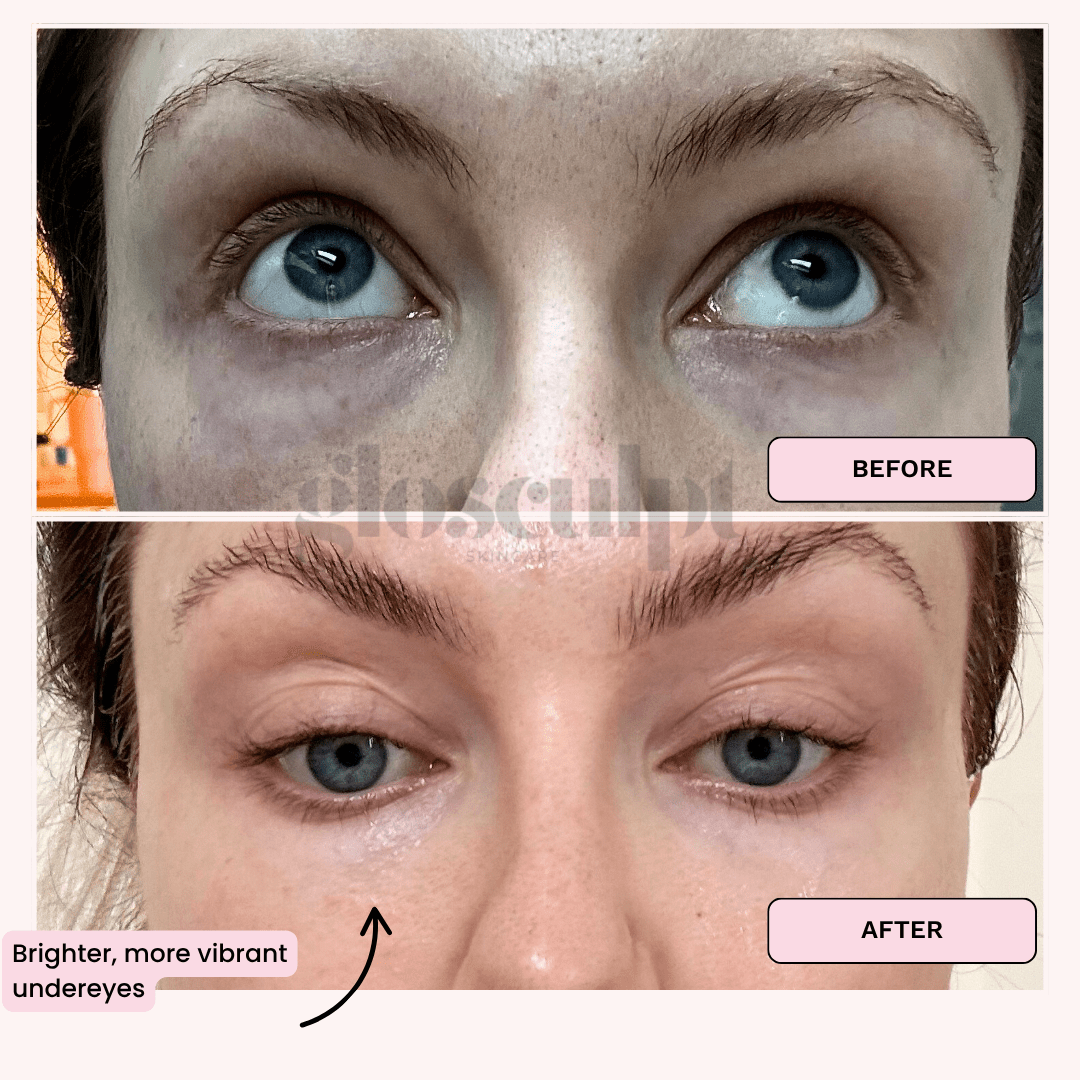 Eye Renew Pro - Bright Eyes Red Light Mask - GloSculpt Skin