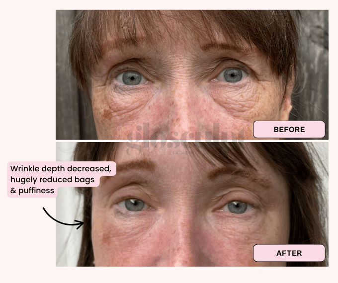 Eye Renew Pro - Bright Eyes Red Light Mask - GloSculpt Skin