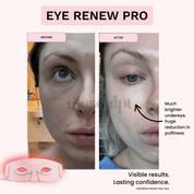 Eye Renew Pro - Wrinkle Eraser Mask - GloSculpt Skin