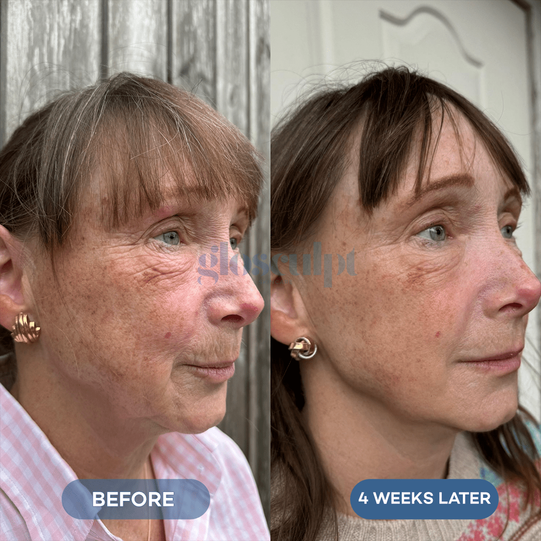 Glo 4 - in - 1 Pro LED Light Therapy Mask - GloSculpt Skin