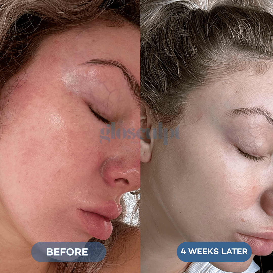 Glo 4 - in - 1 Pro LED Light Therapy Mask - GloSculpt Skin